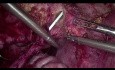 Laparoskopische ureterovesikale Reimplantation
