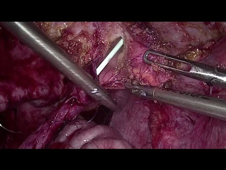 Laparoskopische ureterovesikale Reimplantation