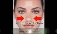 Zustand nach Rhinoplastik - wie man eine Wunde versorgt