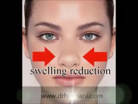 Zustand nach Rhinoplastik - wie man eine Wunde versorgt