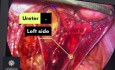 Endometriose des Nervus obturatorius durch Peritonektomie behandeln