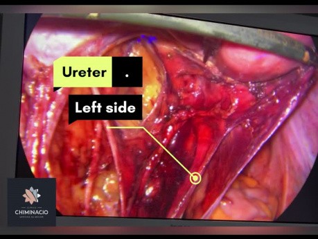 Endometriose des Nervus obturatorius durch Peritonektomie behandeln