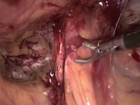 TAPP-Methode: Laparoskopische, minimal invasive Hernienreparation 