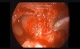 Endoskopische Tympanomastiodektomie