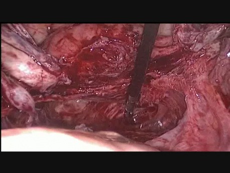 "Kissing ovaries" bei Endometriose