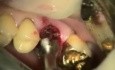 Molaren-Sofortimplantation mit dem Max Dental System