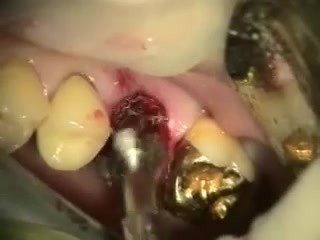 Molaren-Sofortimplantation mit dem Max Dental System