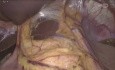Heller-Myotomie mit Toupet-Fundoplikatio