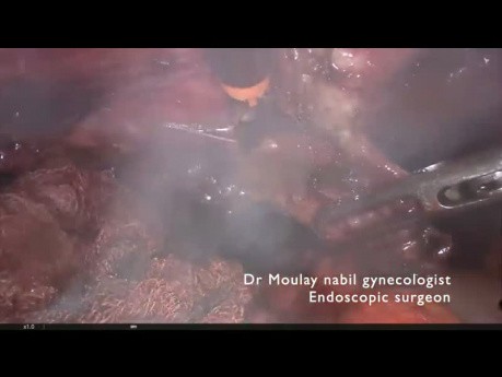Tief infiltrierende Endometriose, Ureterolyse, Resektion der uterosakrale Ligamente