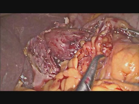 Ösophagus-Bougie-Perforation - intraoperative Behandlung