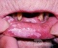 Hyperkeratose der Lippe [Leukoplakie]