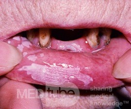 Hyperkeratose der Lippe [Leukoplakie]