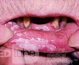 Hyperkeratose der Lippe [Leukoplakie]