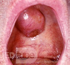Pleomorphes Adenom des Gaumens