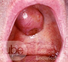Pleomorphes Adenom des Gaumens