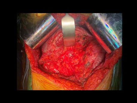Thrombose und Leberpseudotumoren: Klatskin Typ 3a