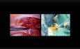 Die Operation der u̱rsprüngliche Inguinalhernie , TAPP Methode