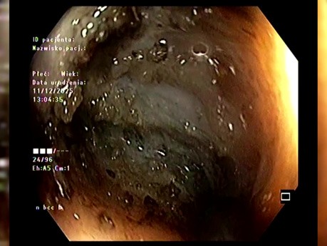 Endoskopische Submukosadissektion (ESD) eines rektalen SMT