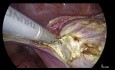 Totale laparoskopische Hysterektomie – spielt die Größe eine Rolle?