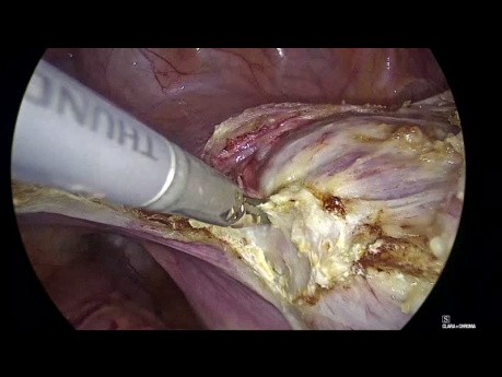 Totale laparoskopische Hysterektomie – spielt die Größe eine Rolle?