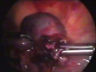 Entfernung der extrauterine Schwangerschaft durch laparoskopische Methode