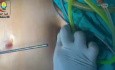 Beevor-Zeichen und Portplatzierung in der laparoskopischen Chirurgie