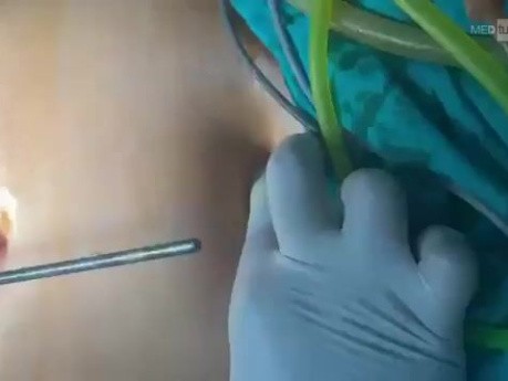 Beevor-Zeichen und Portplatzierung in der laparoskopischen Chirurgie