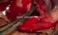 Netzhautablösung