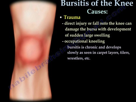 Ursachen der Kniebursitis - Video-Vorlesung