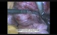 Laparoskopische Resektion des Myoms des breiten Gebärmutterbandes