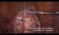 Ambulante laparoskopische Myomektomie
