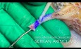 End-zu-Seit-Anastomose Obere Polararterie an Nierenarterie
