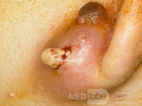 Infizierte Epidermoidzyste - Drainage
