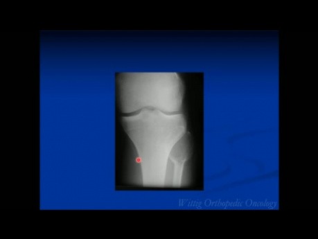 Kurs Orthopädische Onkologie - Unbekannte klinische Fälle - Teil A (Fälle 1-10) - Vortrag 11