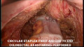 Niedrige anteriore laparoskopische Rektumresektion bei Rektumkarzinom: Schritt für Schritt