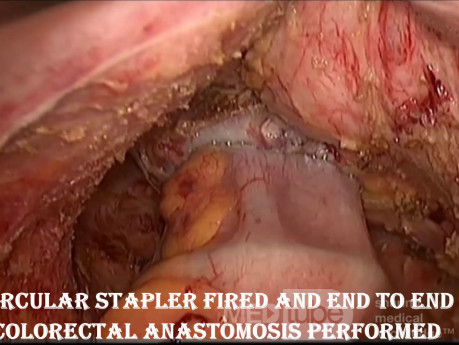 Niedrige anteriore laparoskopische Rektumresektion bei Rektumkarzinom: Schritt für Schritt