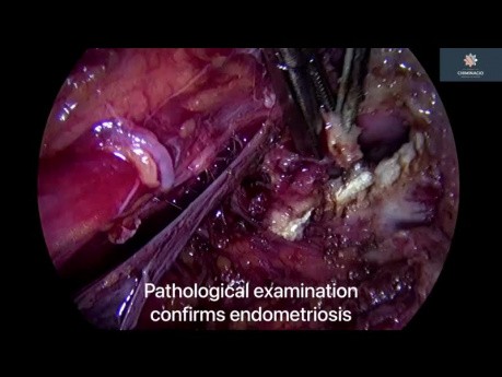 Tiefe Parametrium-Endometriose und diffuse Peritonealerkrankung - Peritonektomie des hinteren Kompartiments
