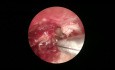 Cholesteatom-Chirurgie: Endoskopischer und mikroskopischer Ansatz