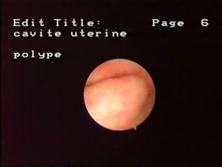 Diagnostische Hysteroskopie zur Diagnostik der Polypen des Endometriums