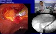 Implantation eines Pankreasstents
