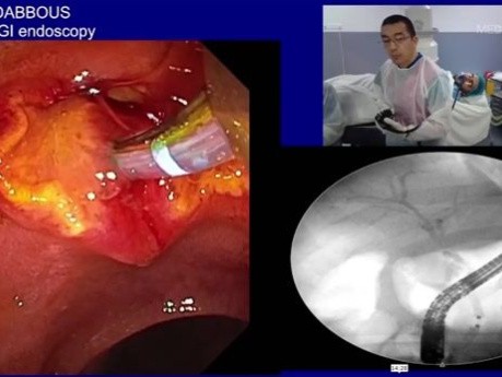 Implantation eines Pankreasstents