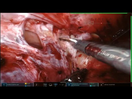 Modifizierte Pauli's Ileum Conduit Parastomale Hernienreparatur