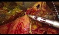Laparoskopische doppelte Bypass-Anastomose bei inoperablem Bauchspeicheldrüsenkrebs