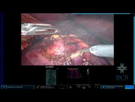 Tipps und Tricks: Roboter-partielle Nephrektomie bei einem 100 % endophytischen Tumor