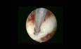 Uterus subseptus- hysteroskopische Septumdissektion