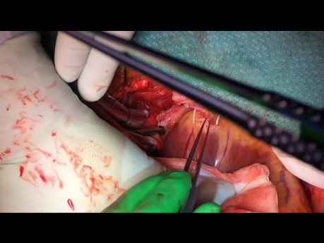 Koronararterienbypass (CABGx4) mit kardiopulmonalem Bypass
