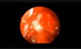 Traumatische Optikusneuropathie – Endoskopische Dekompression