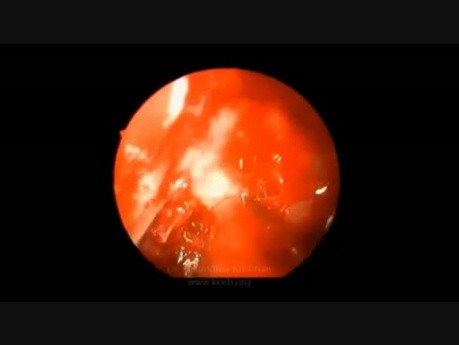 Traumatische Optikusneuropathie – Endoskopische Dekompression