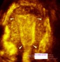 Gebärmutterhöhle (cavum uteri)-  3D-Sonografie