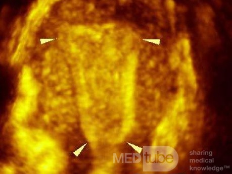 Gebärmutterhöhle (cavum uteri)-  3D-Sonografie